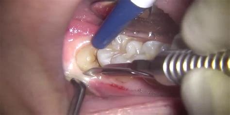 20 Lik Diş Çıkarma Belirtileri Nelerdir?